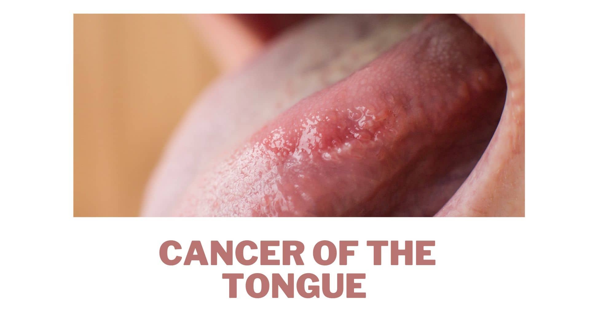 Cancer Of The Tongue 1 